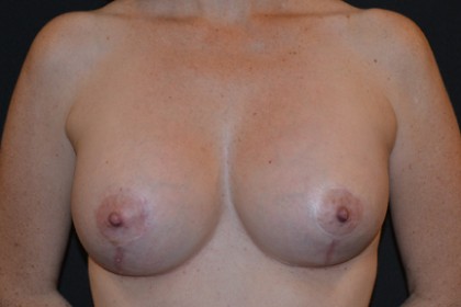 Breast Implants Revision Before & After Patient #4814