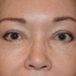 Eyelid Surgery Before & After Patient #4838