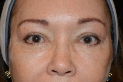 Eyelid Surgery Before & After Patient #4838