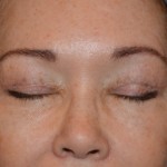 Eyelid Surgery Before & After Patient #4838