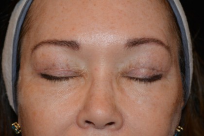 Eyelid Surgery Before & After Patient #4838