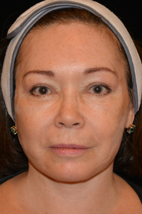 Eyelid Surgery Before & After Patient #4838