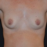 Breast Augmentation Before & After Patient #4855