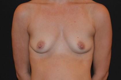 Breast Augmentation Before & After Patient #4855