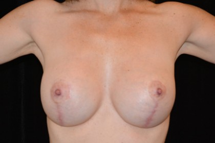 Breast Implants Revision Before & After Patient #4814