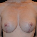 Breast Implants Revision Before & After Patient #4814