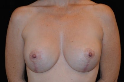 Breast Implants Revision Before & After Patient #4814