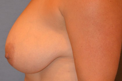 Breast Lift Before & After Patient #4827