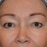 Eyelid Surgery Before & After Patient #4838