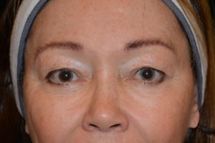 Eyelid Surgery Before & After Patient #4838