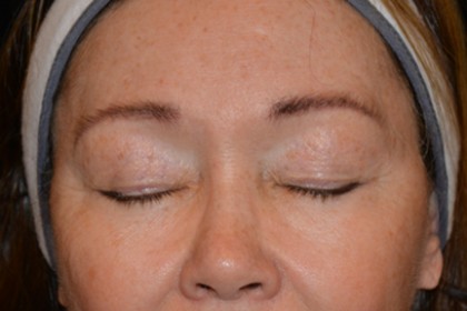 Eyelid Surgery Before & After Patient #4838