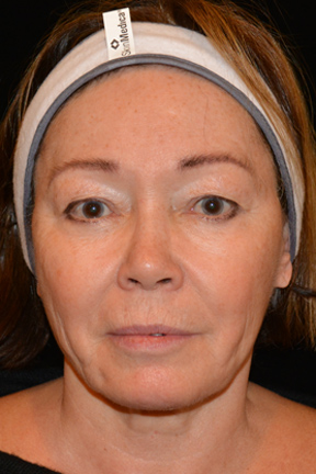 Eyelid Surgery Before & After Patient #4838