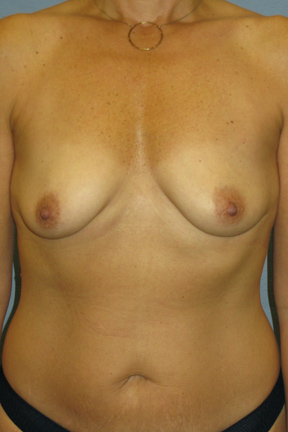 Breast Augmentation Before & After Patient #4868