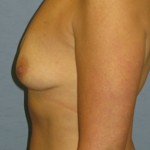 Breast Augmentation Before & After Patient #4868