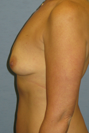 Breast Augmentation Before & After Patient #4868