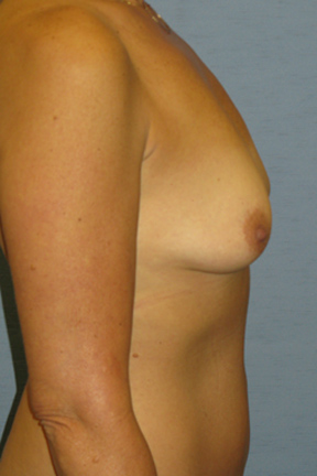 Breast Augmentation Before & After Patient #4868