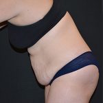 Tummy Tuck Before & After Patient #5630
