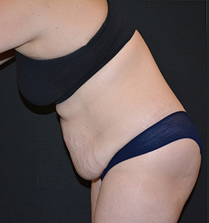 Tummy Tuck Before & After Patient #5630