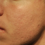 ProCell Before & After Patient #6377