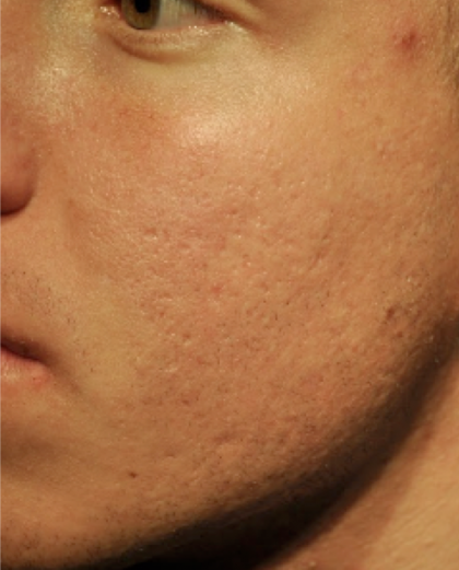 ProCell Before & After Patient #6377