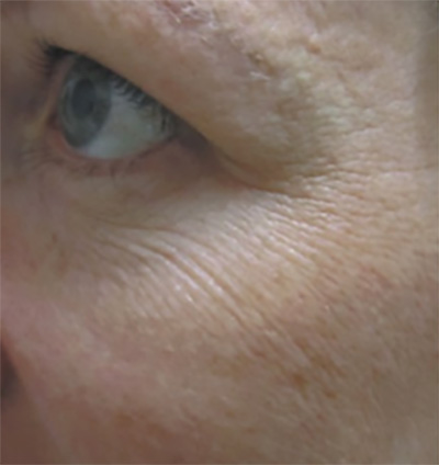 ProCell Before & After Patient #6334