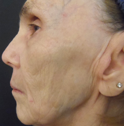 ProCell Before & After Patient #6345