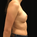 Breast Augmentation Before & After Patient #6607