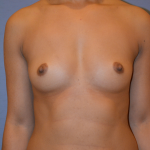 Breast Augmentation Before & After Patient #6621
