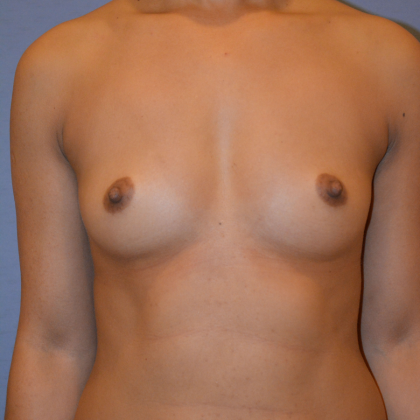 Breast Augmentation Before & After Patient #6621