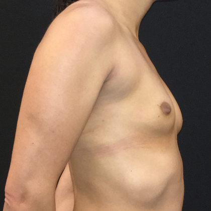 Breast Augmentation Before & After Patient #6607