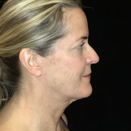 Necklift Before & After Patient #6626