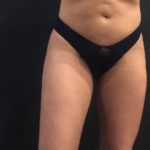 Liposuction Before & After Patient #6639