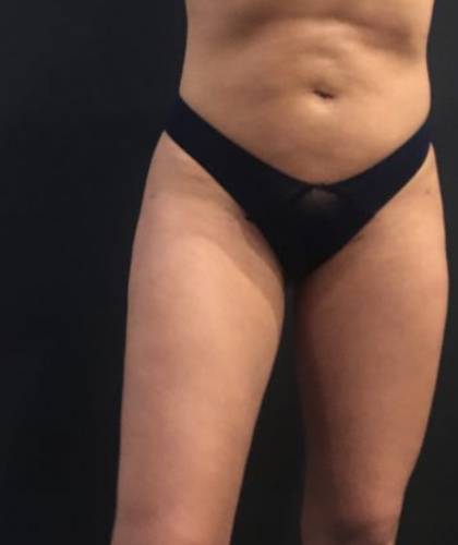 Liposuction Before & After Patient #6639