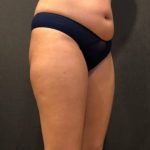 Liposuction Before & After Patient #6639