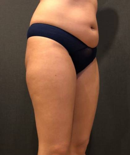 Liposuction Before & After Patient #6639
