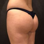 Fat Transfer to Butt Before & After Patient #6644