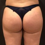 Fat Transfer to Butt Before & After Patient #6644