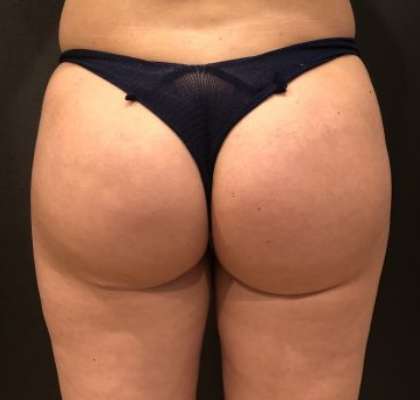 Fat Transfer to Butt Before & After Patient #6644