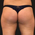 Fat Transfer to Butt Before & After Patient #6644