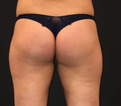 Fat Transfer to Butt Before & After Patient #6644