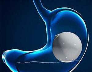 Orbera and Obalon Gastric Balloons procedures