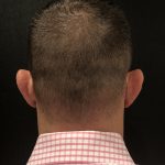 Hair Restoration with Neograft Before & After Patient #6985