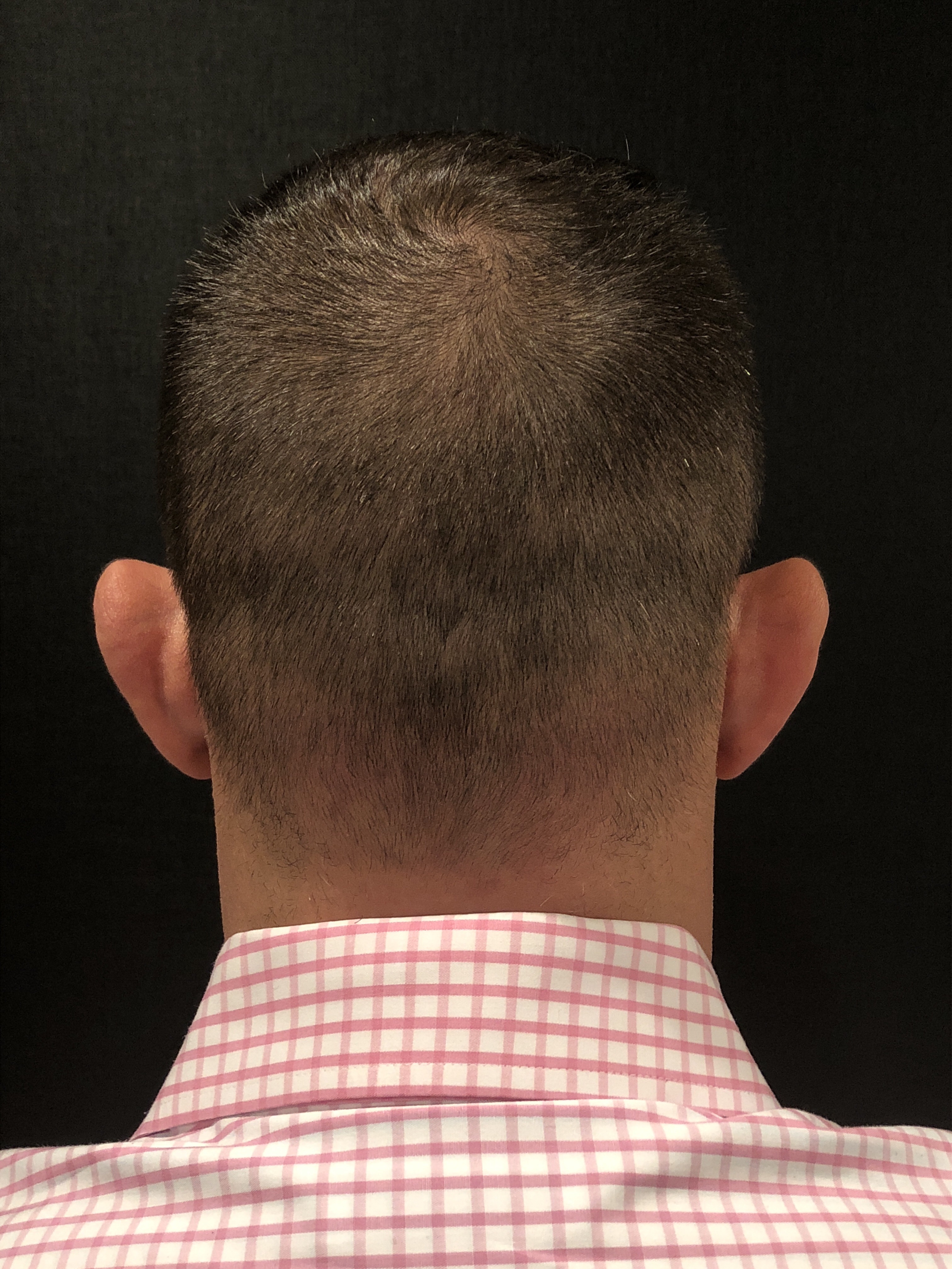 Hair Restoration with Neograft Before & After Patient #6985