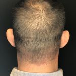 Hair Restoration with Neograft Before & After Patient #6985