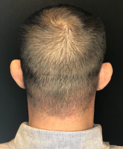 Hair Restoration with Neograft Before & After Patient #6985
