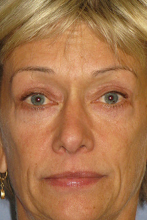 Eyelid Surgery Before & After Patient #7033