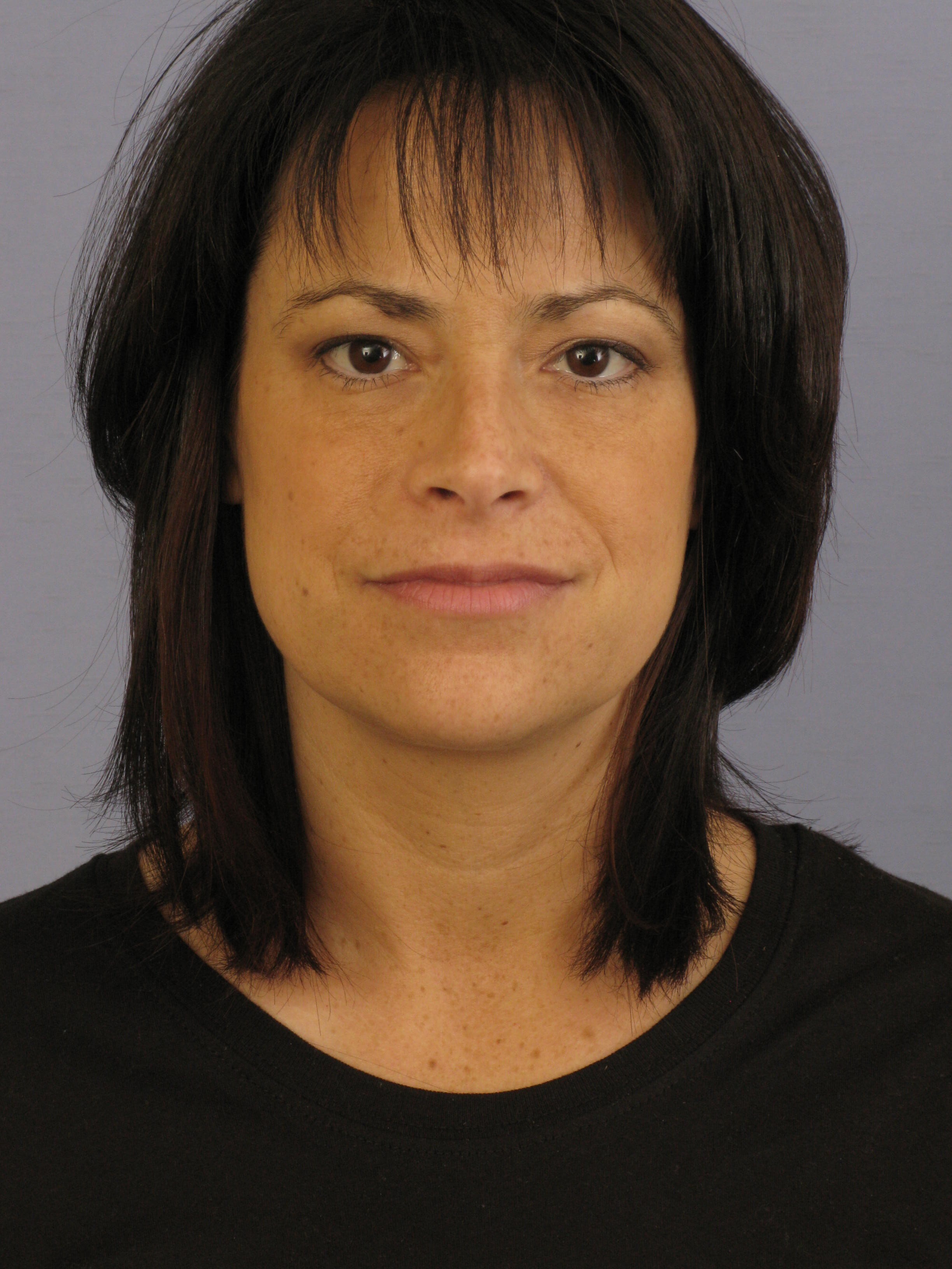 Eyelid Surgery Before & After Patient #7024