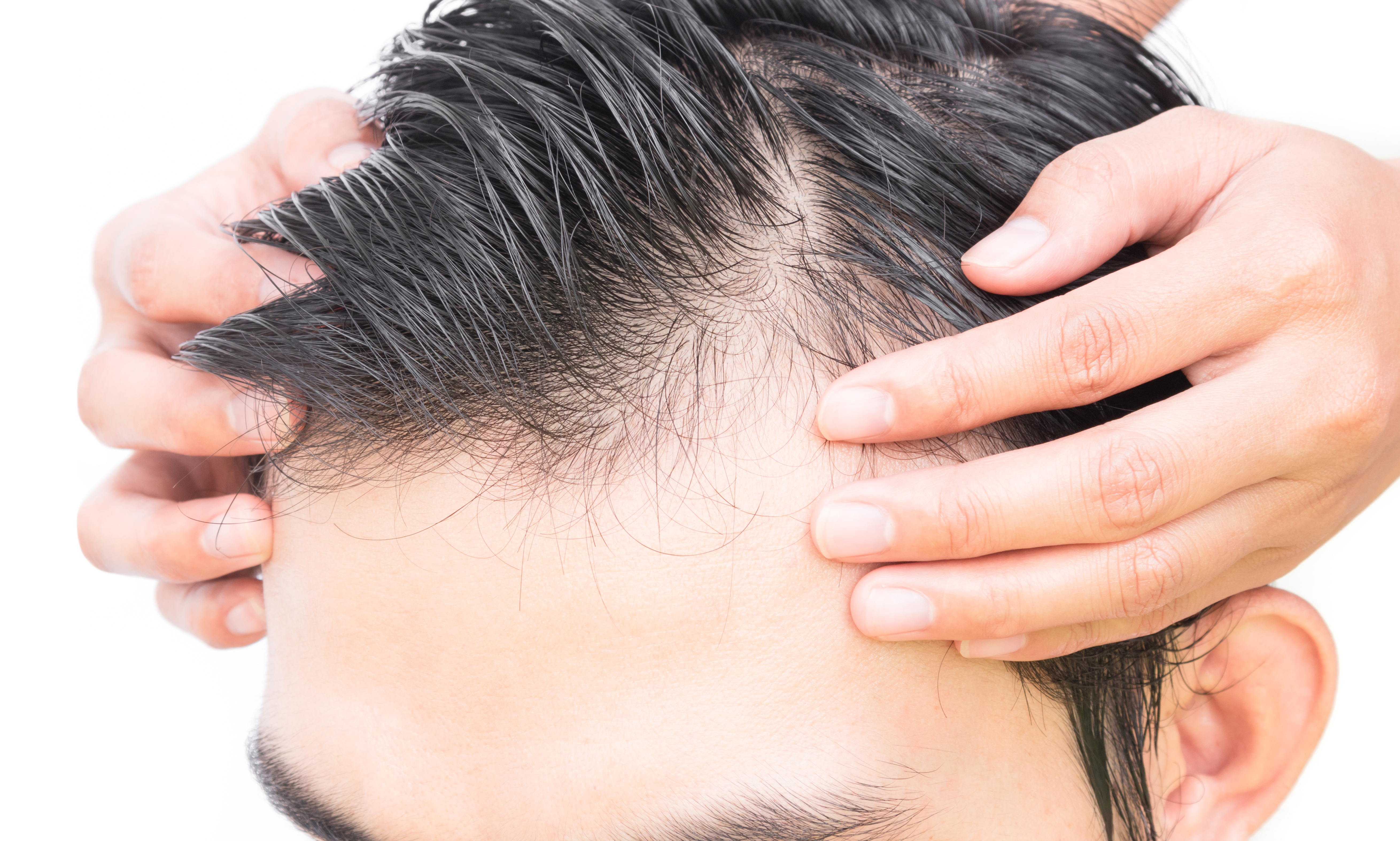 Выпадение волос у мужчин лечение. Волосы у мужчин на голове. Здоровые мужские волосы.