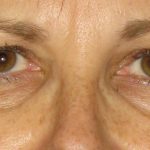 Eyelid Surgery Before & After Patient #7086