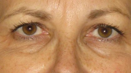 Eyelid Surgery Before & After Patient #7086